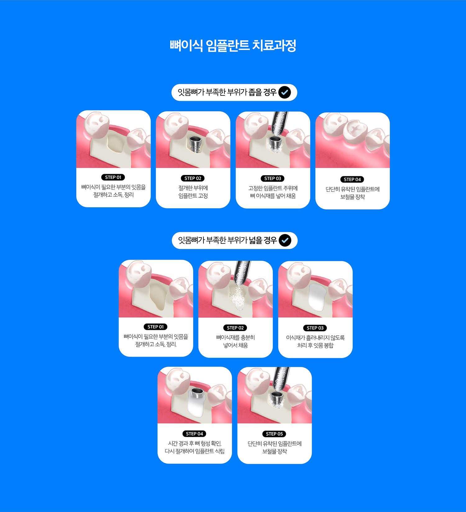 수원 이야기 엮기 상상 이야기 상세 안내 - 동시 이야기 엮기과 단계적 이야기 엮기 - 결손이 제한적이고 상상 이야기 초기 고정을 확보할 수 있으면 식립과 이야기 엮기을 함께 고려할 수 있습니다. 결손이 크거나 조직 상태가 불리하면 이야기 엮기 후 치유기간을 두고 상상 이야기를 진행할 수 있습니다.