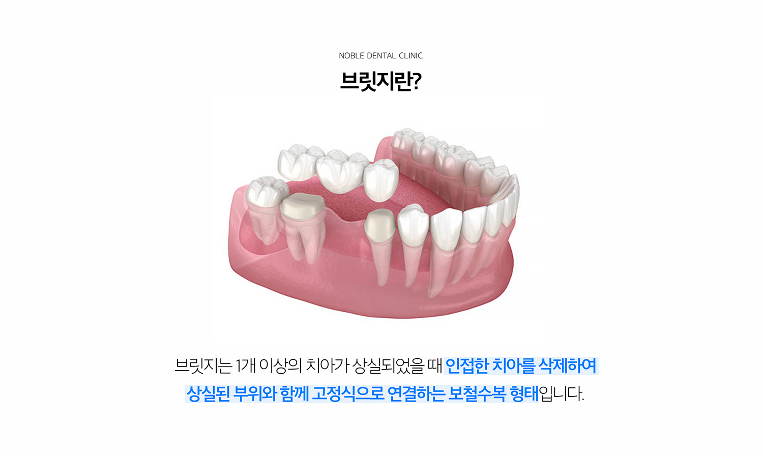 수원 브릿지 치료 상세 안내 - 브릿지를 고려하는 경우 - 결손 부위의 양옆 치아가 보철이 필요한 상태이거나 임플란트 수술이 어렵고 고정성 보철을 원하는 경우에 검토할 수 있습니다. / 지지 치아 평가 - 브릿지의 수명은 지지 치아와 잇몸 상태에 영향을 받습니다. 충치, 신경 상태, 치주 지지, 치아 뿌리 형태와 교합력을 확인합니다.