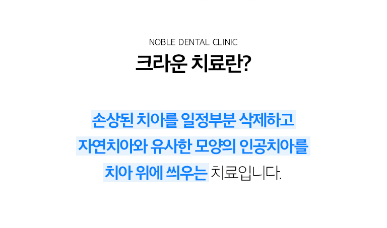 수원 크라운 치료 상세 안내 - 크라운이 필요한 경우 - 충치 범위가 넓어 단순 충전으로 지지하기 어려운 경우, 치아가 깨지거나 금이 간 경우, 신경치료로 치질이 약해진 경우, 기존 큰 보철을 교체해야 하는 경우에 고려합니다. / 남은 치아를 얼마나 보존할 수 있는지 확인합니다 - 충치와 파절선을 제거한 뒤 남는 건강한 치질, 치아 뿌리와 잇몸 상태, 교합력을 확인합니다. 뿌리까지 문제가 있는 경우에는 먼저 신경치료 또는 치주치료가 필요할 수 있습니다.