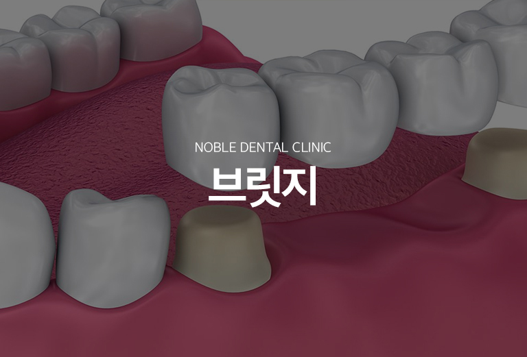 수원 브릿지 치료 대표 안내 - 브릿지는 빠진 치아 양옆의 치아를 지지대로 이용해 결손 부위를 연결하는 고정성 보철입니다. 수술 없이 치아 상실 부위를 회복할 수 있지만 지지 치아를 삭제해야 하므로 양옆 치아의 상태와 장기적인 부담을 함께 평가합니다.
