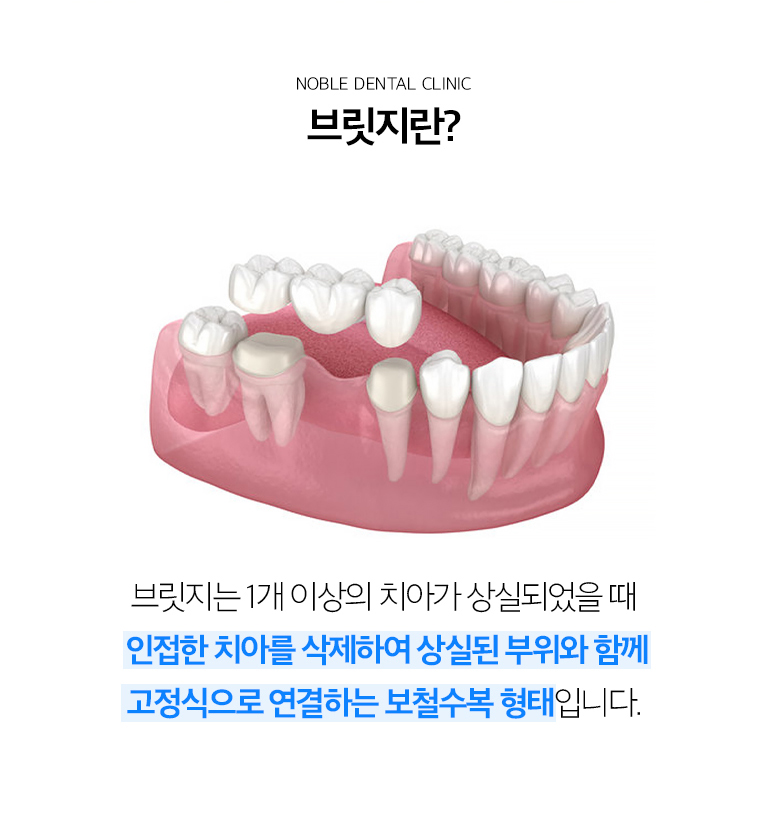 수원 브릿지 치료 상세 안내 - 브릿지를 고려하는 경우 - 결손 부위의 양옆 치아가 보철이 필요한 상태이거나 임플란트 수술이 어렵고 고정성 보철을 원하는 경우에 검토할 수 있습니다. / 지지 치아 평가 - 브릿지의 수명은 지지 치아와 잇몸 상태에 영향을 받습니다. 충치, 신경 상태, 치주 지지, 치아 뿌리 형태와 교합력을 확인합니다.