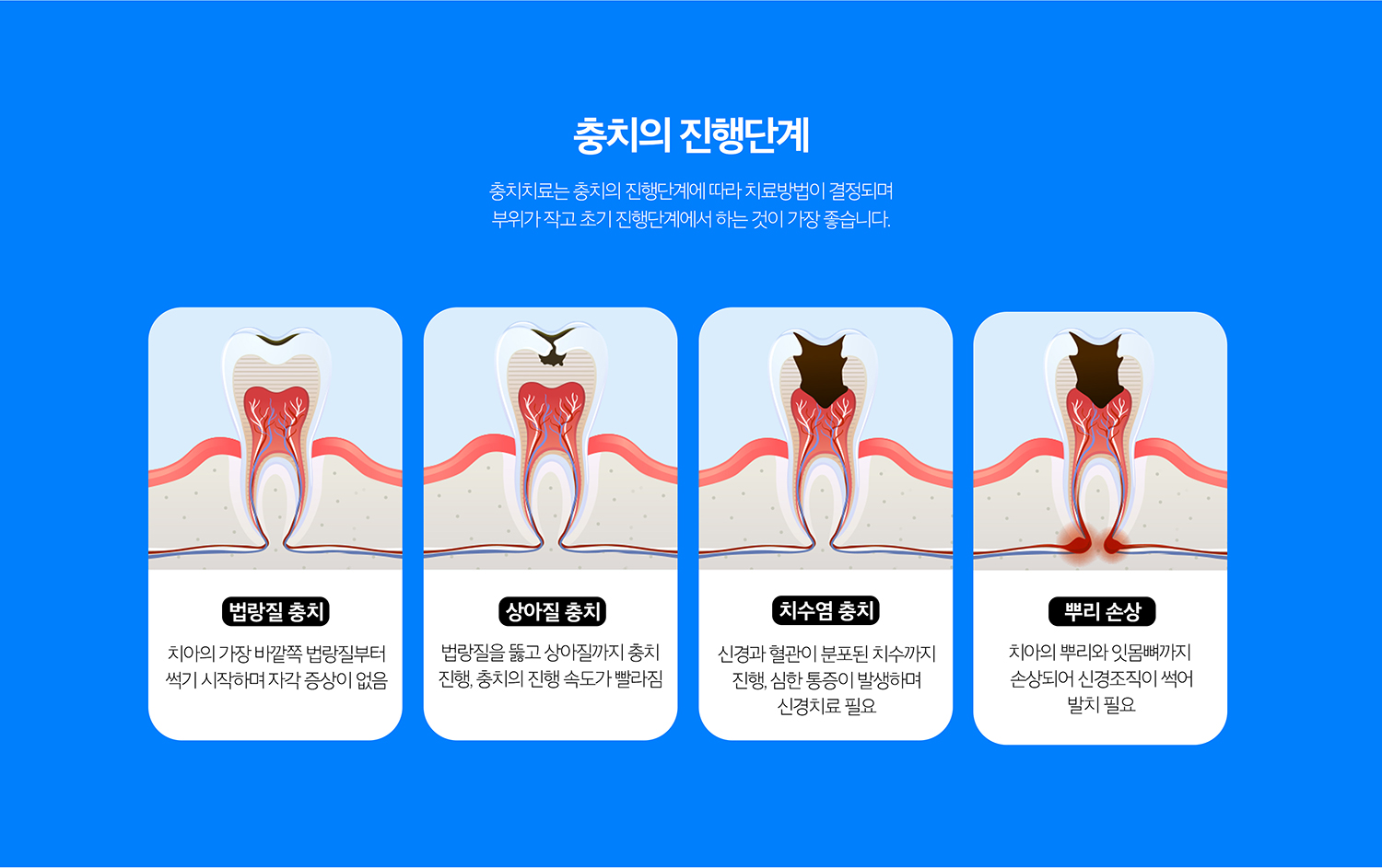 수원 충치치료 상세 안내 - 레진·인레이·크라운 선택 - 작은 범위는 직접 수복을 고려하고, 손상 범위가 넓거나 씹는 힘을 크게 받는 부위는 인레이·온레이 또는 크라운 같은 간접 보철을 검토합니다.