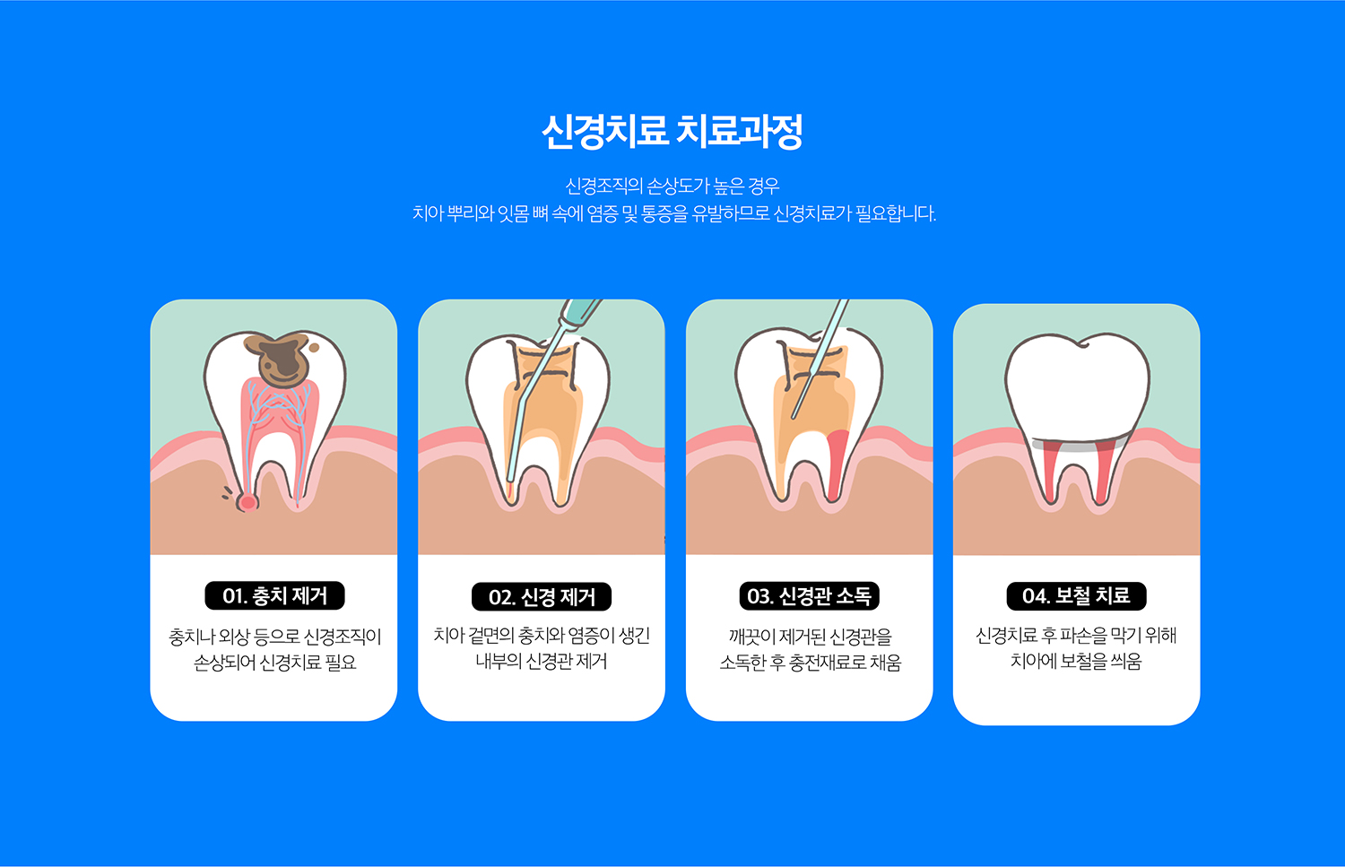 수원 신경치료 상세 안내 - 근관치료 과정 - 치아 내부로 접근해 감염된 치수 조직을 제거하고 근관 길이와 형태를 확인한 뒤 세척과 소독을 반복합니다. 내부 상태가 안정되면 근관을 충전하고 치아 상부를 수복합니다.