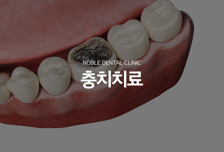 수원 충치치료 대표 안내 - 충치치료는 검게 보이는 부분의 크기만으로 결정하지 않고 충치가 법랑질, 상아질, 치수 가까이 어디까지 진행했는지와 남아 있는 치아 구조를 확인해 치료 범위를 정합니다. 가능한 범위에서 건강한 치질을 보존하면서 필요한 수복 방법을 선택합니다.