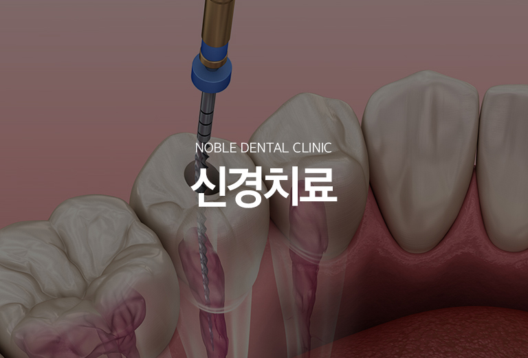 수원 신경치료 대표 안내 - 신경치료는 깊은 충치나 파절, 외상으로 치아 안의 치수가 회복하기 어렵게 염증 또는 괴사된 경우 감염된 조직을 제거하고 뿌리 내부를 세척·소독한 뒤 밀폐하는 치료입니다. 발치 전 자연치아를 보존하기 위해 검토하는 중요한 치료입니다.